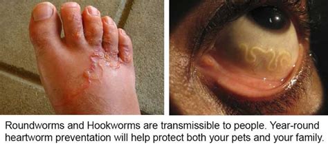 How To Test For Hookworms In Humans Toxoplasmosis