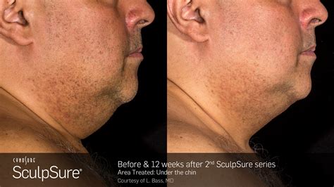 Double Chin Fat Removal Nyc Sculpsure Dr Jennifer Levine