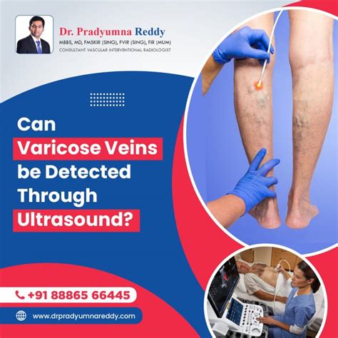 Can Varicose Veins Be Detected Through Ultrasound