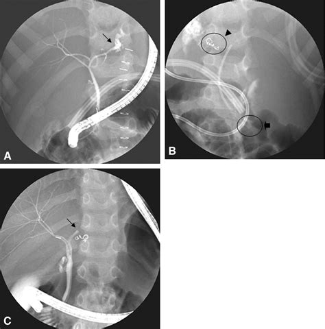 Role Of Ercp In The Management Of Non Iatrogenic Traumatic Bile Duct