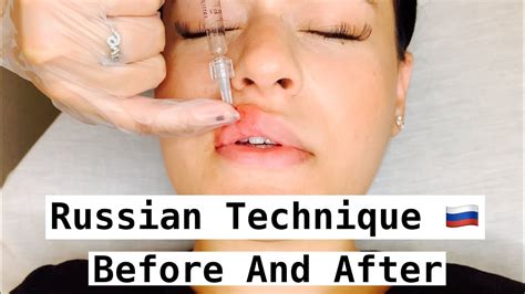 Russian Lip Technique With Before And After Youtube