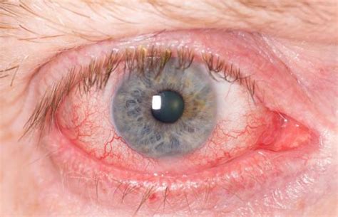What Are The Symptoms Of Eye Parasites With Pictures