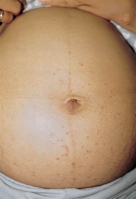 Pruritic Folliculitis Of Pregnancy Journal Of The American Academy Of