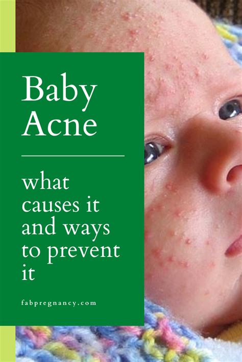 Baby Acne What Causes It And Ways To Prevent It Baby Acne Baby Acne