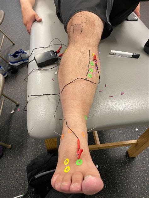 Dry Needling With Ims Plantar Fascia Institute Of Mn