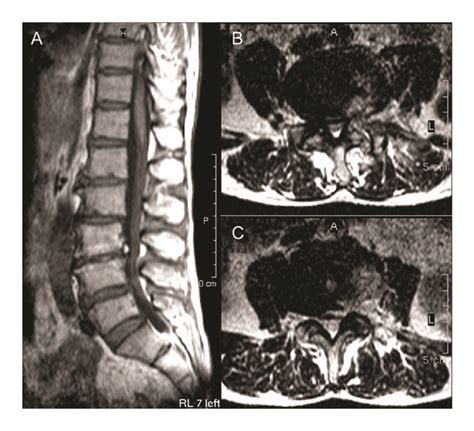 Lumbar Scoliosis Combined Lumbar Spinal Stenosis And Herniation