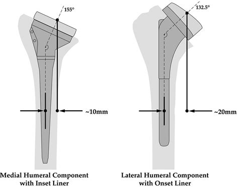 Rtsa Humeral Prosthesis Design Classification Examples Of A Medial
