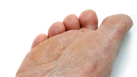 Athletes Foot Causes Symptoms And Diagnosis