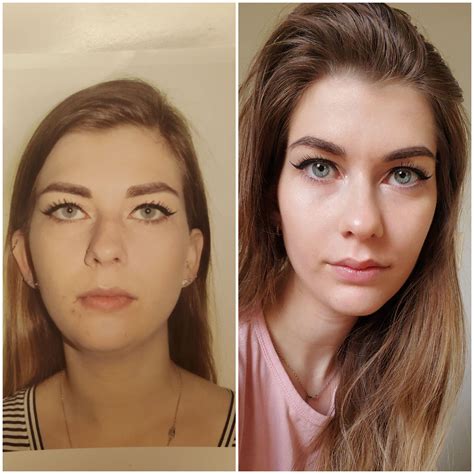Before And After Having Double Jaw Surgery For Overbite A 3 Piece Lefort