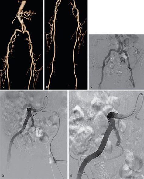 Pelvic And Lower Extremity Arteries Radiology Key