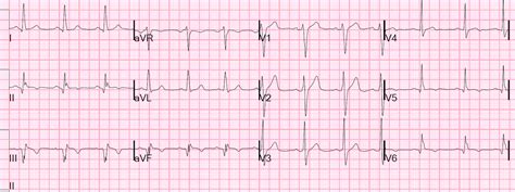 Electrocardiography in suspected myocardial infarction has the main purpose of detecting ischemia or acute coronary injury in emergency department populations coming for symptoms of myocardial infarction (mi). Dr. Smith's ECG Blog: Inferior MI with positive troponin ...