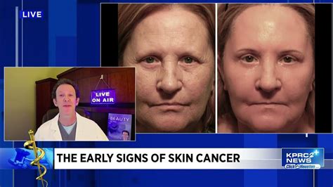 Cosmetic Surgeon Shares How To Spot Signs Of Skin Cancer Youtube