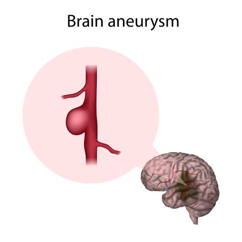 Brain Aneurysms Types Causes Symptoms And Treatment