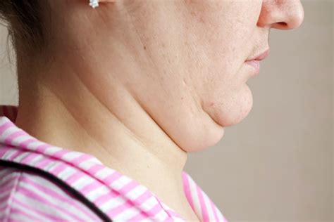 What Causes A Double Chin Here Are 6 Primary Causes