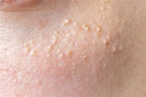 Skin Lesions Types With Chart Pictures Causes Treatment