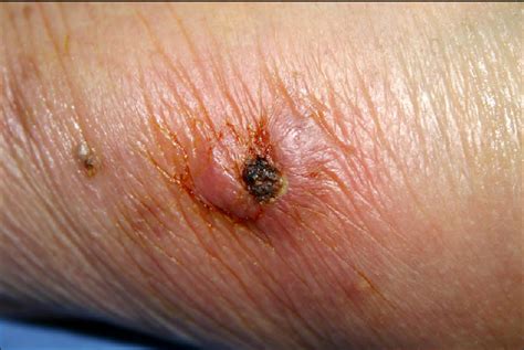 Figure 5 From A Case Of Skin And Soft Tissue Infection Caused By