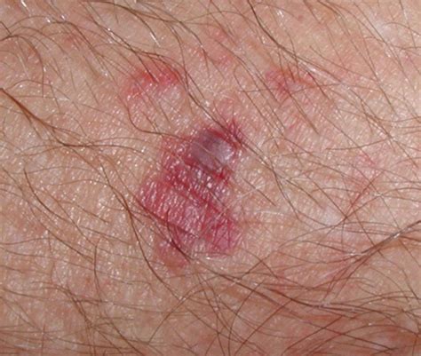 Staph Infection Of The Skin Pictures Photos