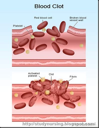 Deep Vein Thrombosis Dvt Blood Clot In The Legs Studynursing