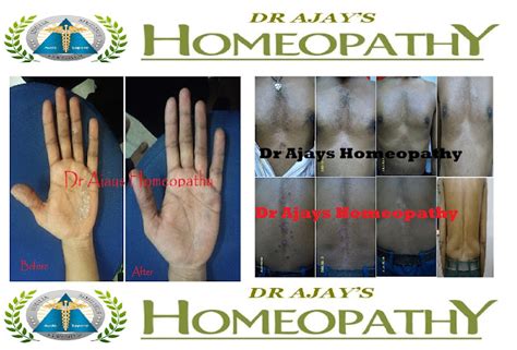 Dr Ajays Homeopathy Every Skin Disease Find Perfect Cure In Homeopathy