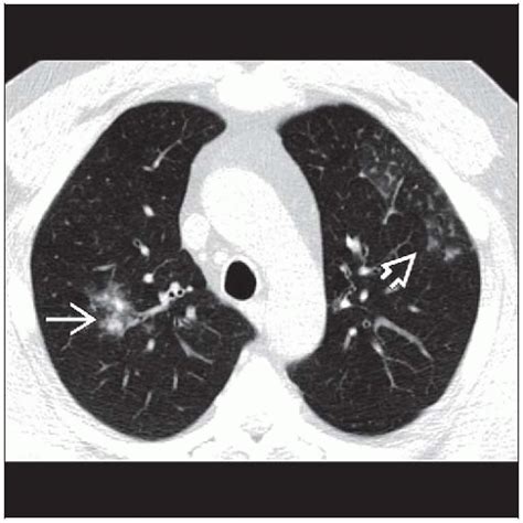 Viral Pneumonia Ct Scan Pneumonia 2020