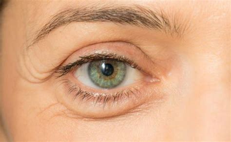 What Causes Puffy Eyes What Are The Symptoms And Treatment