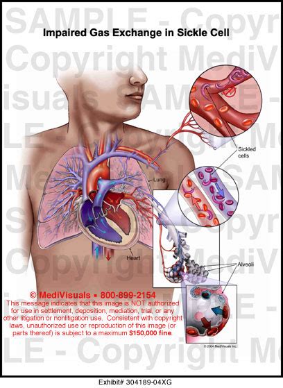 Impaired Gas Exchange In Sickle Cell Medical Illustration Medivisuals