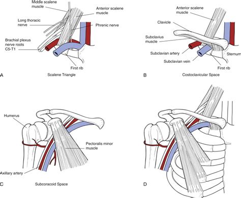 Supraclavicular Approach For Surgical Treatment Of Thoracic Outlet