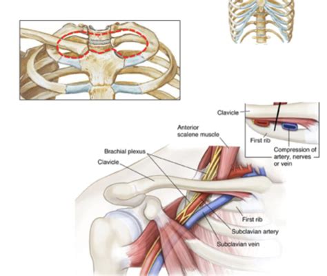 Introduction To Brachial Plexus Injuries Flashcards Quizlet