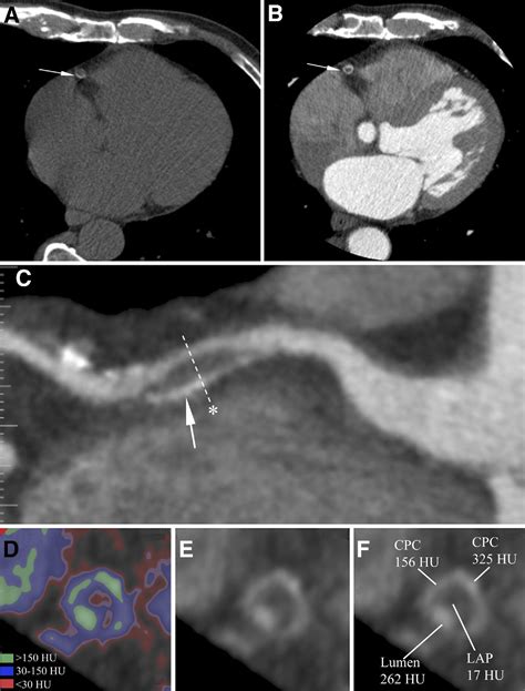 Computed Tomographic Angiographyverified Plaque Characteristics And