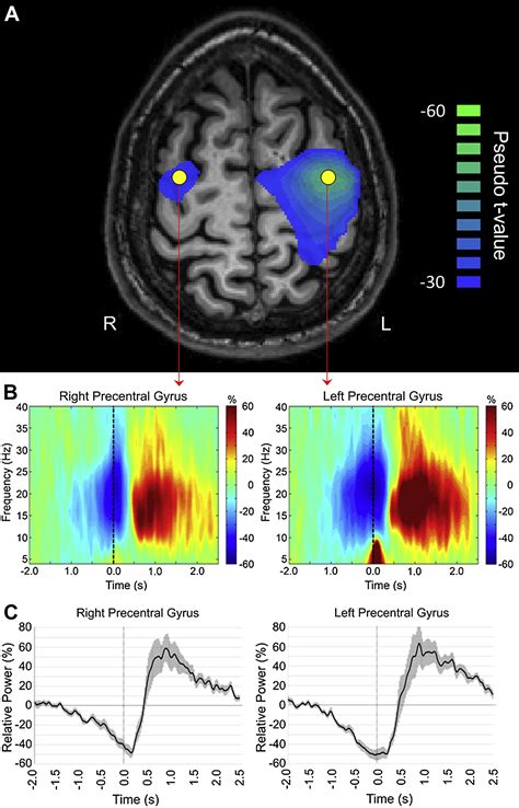 Neuroimaging With Magnetoencephalography A Dynamic View Of Brain