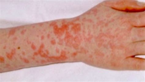 North West Has Highest Rate Of Scarlet Fever Which Is Caused By Strep A