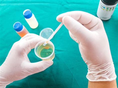 Bilirubine test d urine Procédure préparation et risques
