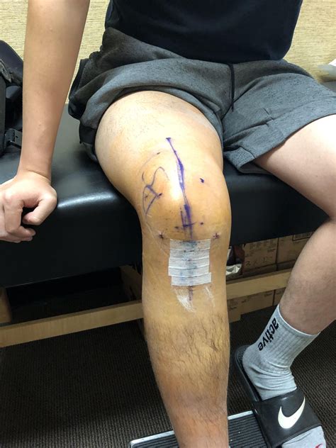 Acl Surgical Vs Non Operative Management Central Performance