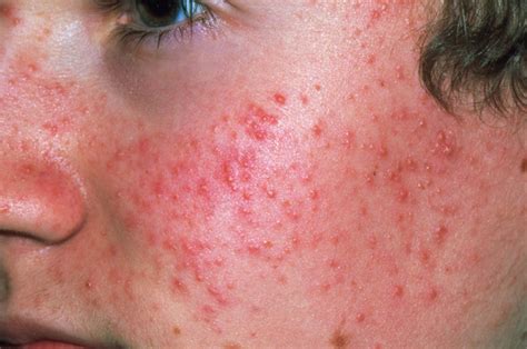 Acne Symptoms And Diagnosis Hseie