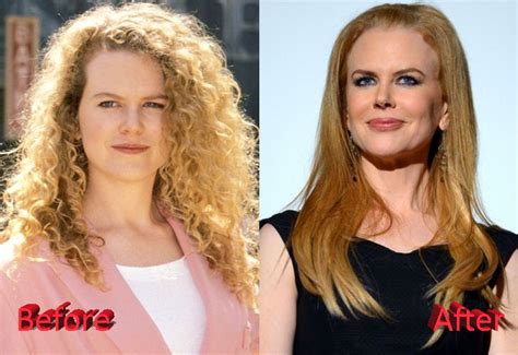 Nicole Kidman Plastic Surgery Pretty Big Changes