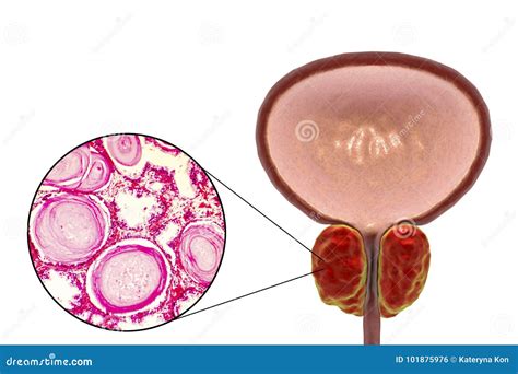 Hiperplasia Prostática Benigna Stock de ilustración Ilustración de salud zoom