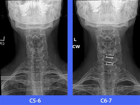 Pre Post Surgical Images Lumbar Artificial Disc Replacement Houston Tx