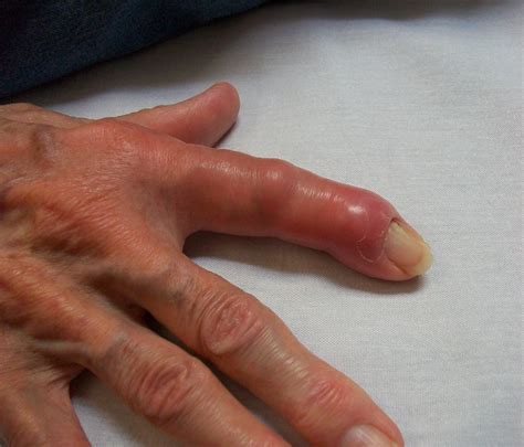 Swollen Finger Infection Treatment