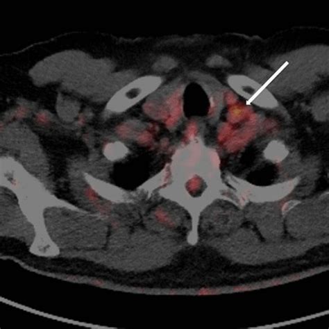 Fdg Pet Scan Showing Left Supraclavicular Lymph Nodes With Moderate