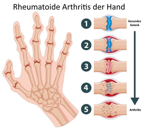 Polyarthritis Infos Spezialisten Zur Rheumatoiden Arthritis