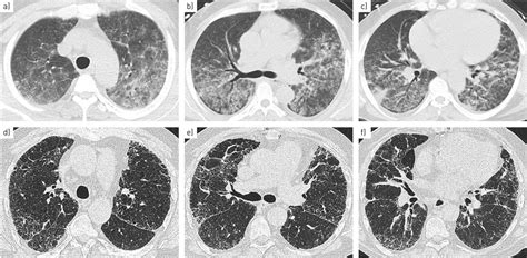 Differential Diagnosis Of Granulomatous Lung Disease Clues And