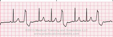 Multifocal Premature Ventricular Contractions