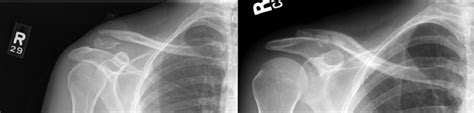 Left A Displaced Type Ii Distal Clavicular Fracture With Comminution