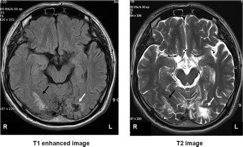 Occipital Lobe Stroke