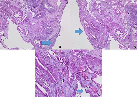 Histologic Findings Of Laryngeal Cystadenoma A Pseudostratified