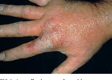 Figure 1 From Therapeutic Options For Chronic Hand Dermatitis