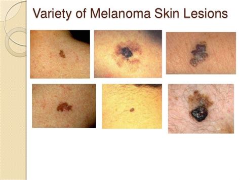 Melanoma Stages Pictures Pictures Photos