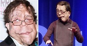 The incredible story of Adam Pearson: He became a movie star despite ...