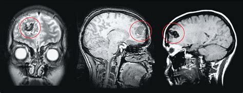 When A Brain Scan Bears Bad News Science