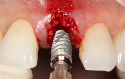 Surgical Placement Of Dental Implants A Restorative Driven Approach
